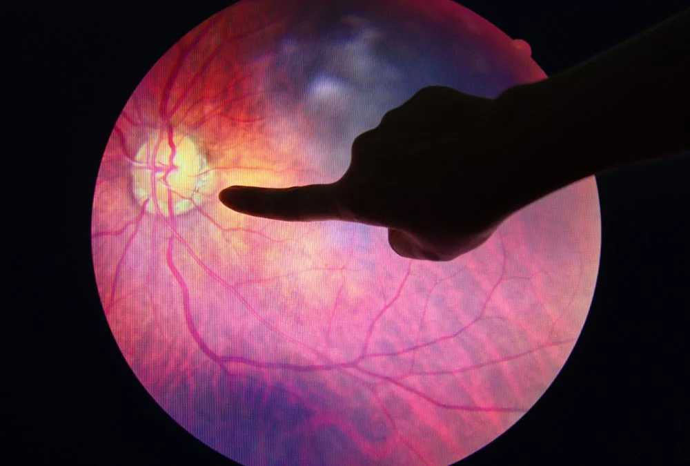 edema_maculare_diabetico_emd