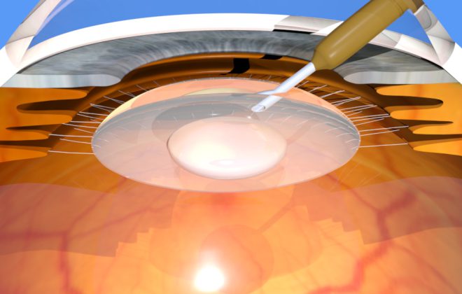 Cause edema maculare cistoide: chirurgia della cataratta