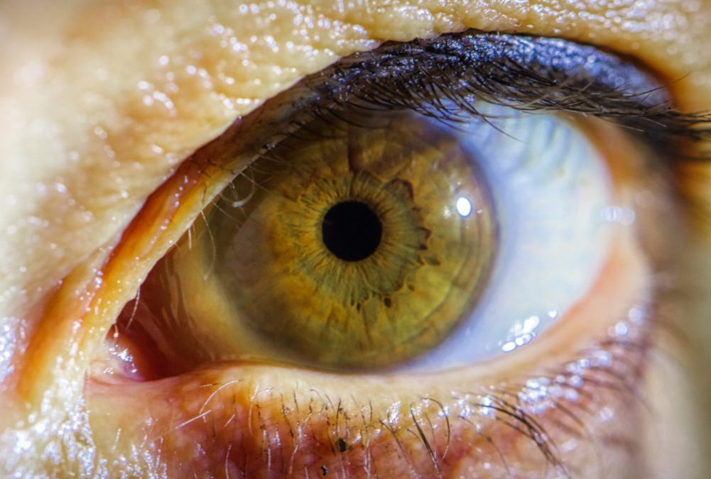 Stadi della retinopatia diabetica