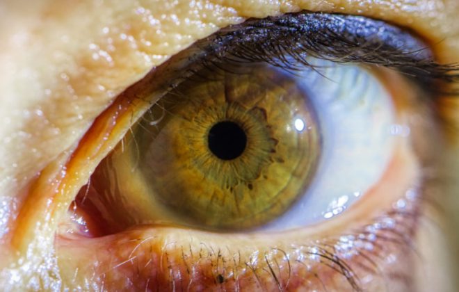 Stadi della retinopatia diabetica