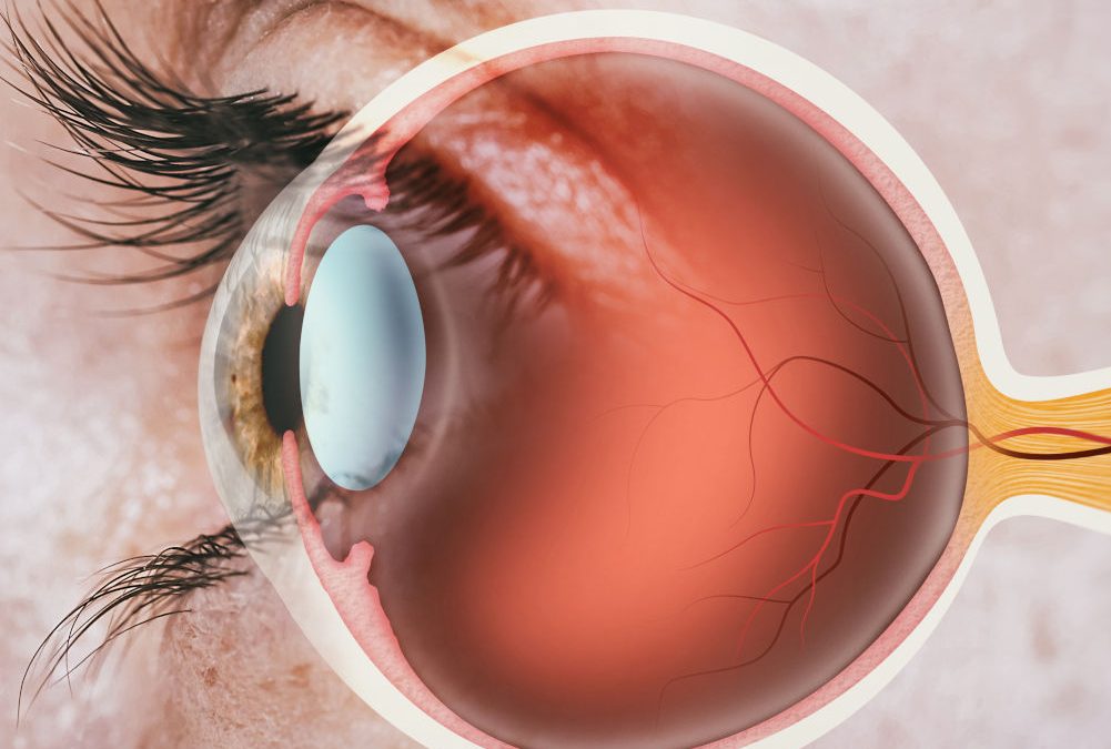 Maculopatia umida o secca le differenze