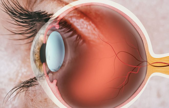 Maculopatia umida o secca le differenze